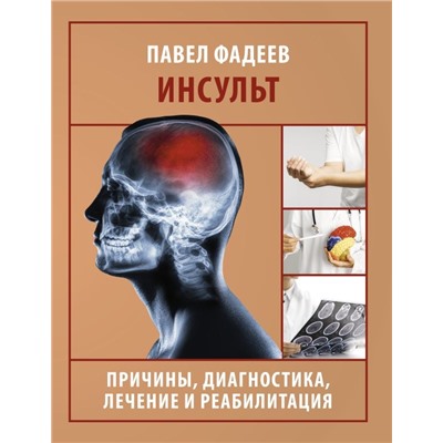 Инсульт. Причины, диагностика, лечение и реабилитация